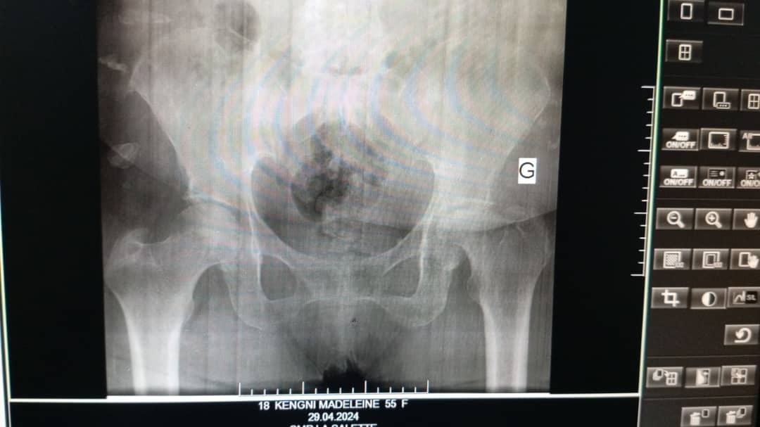 Radio avant l'opération